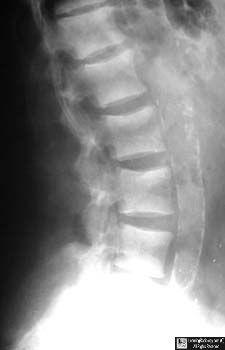 Rugger-jersey spine