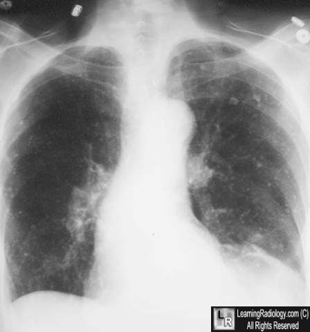 Varicella pneumonia