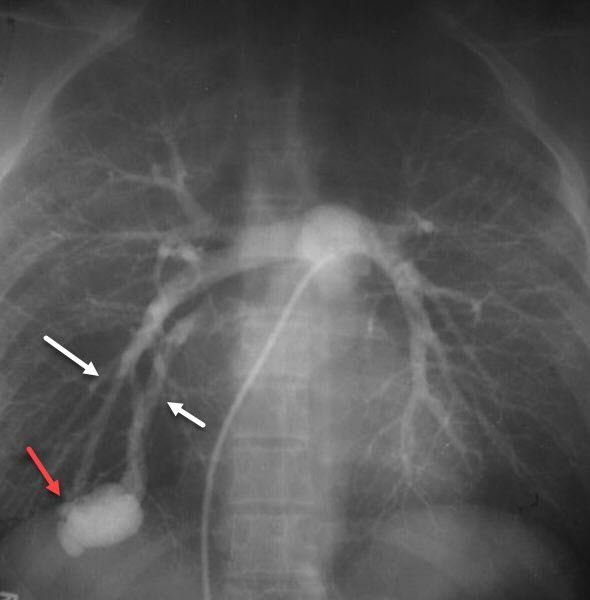 Pulmonary AVM