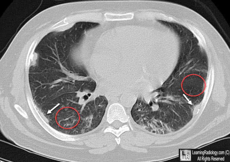 Asbestosis