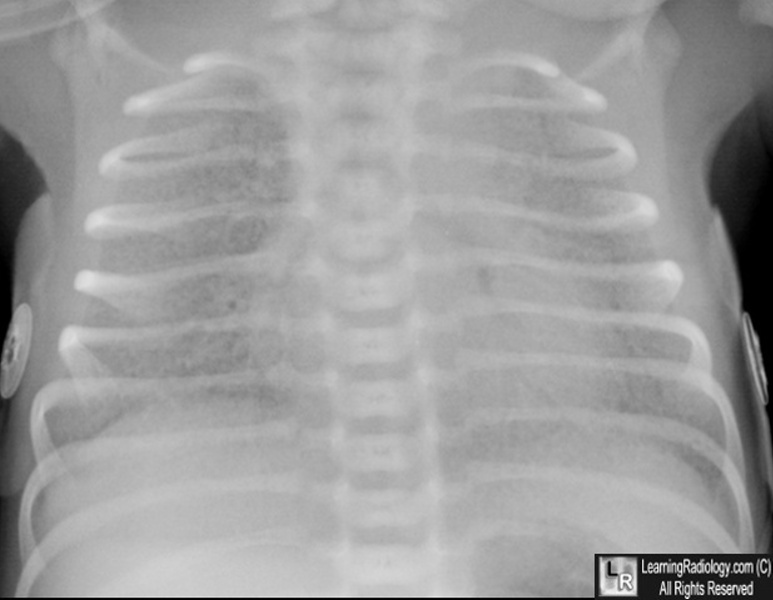 Hyaline Membrane Disease