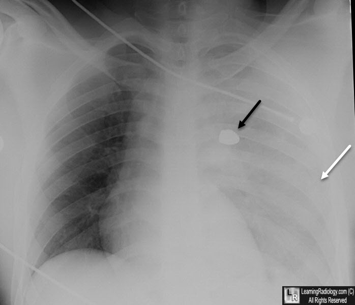 Hemothorax