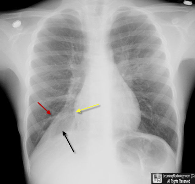 rll, right lower lobe, atelectasis
