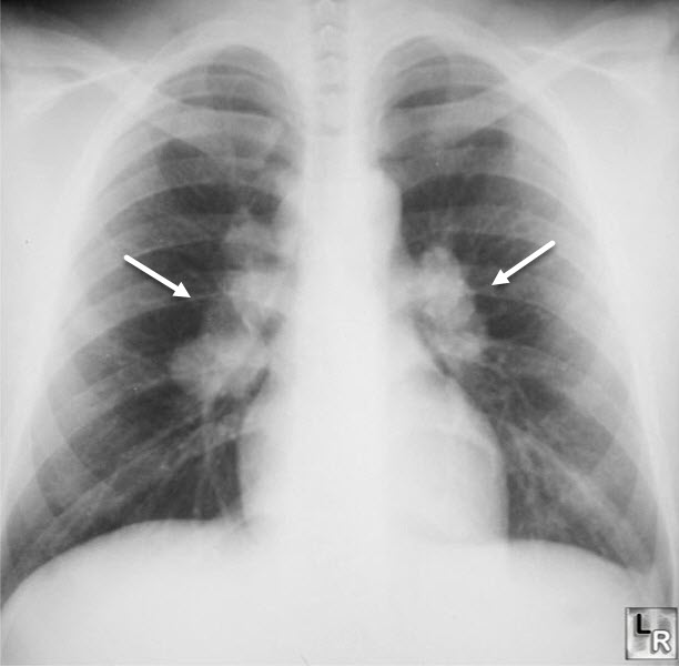 Sarcoidosis