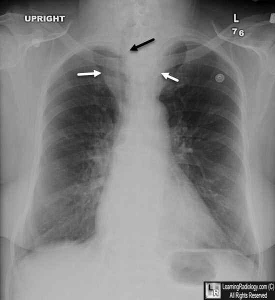 Substernal Thyroid Goiter