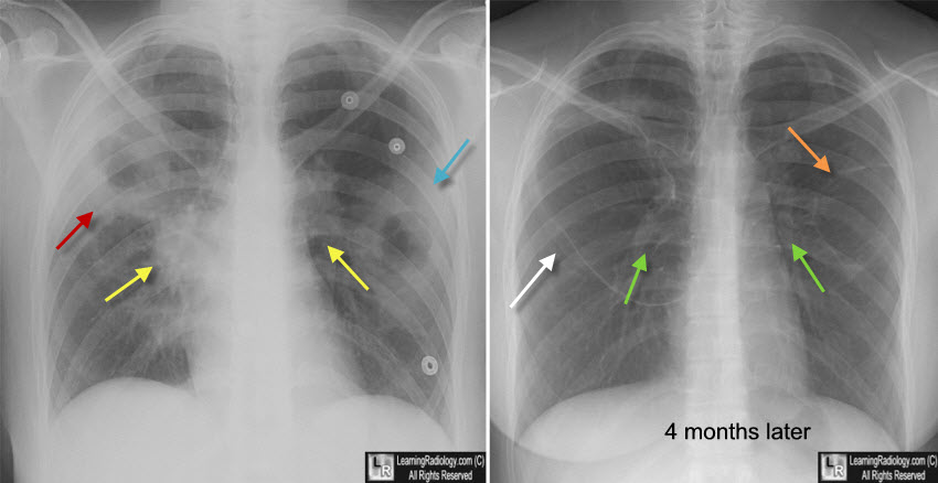 wegener, Granulomatosis with Polyangiitis