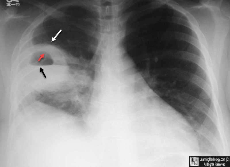 Lung Abscess