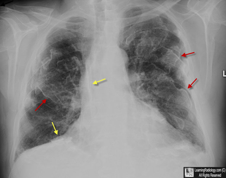 Asbestos-Related Pleural Disease