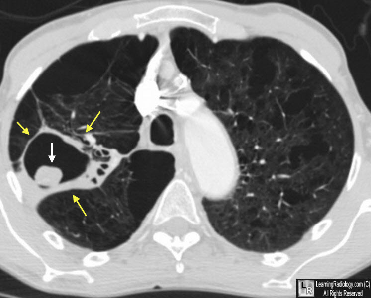 Aspergilloma