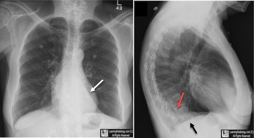 Left lower lobe atelectasis