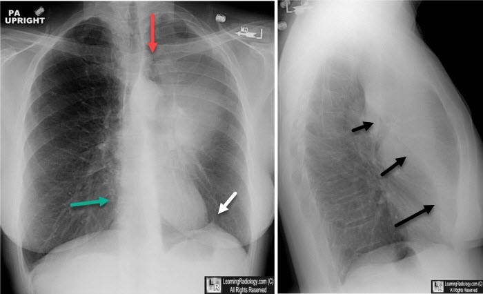 Left Upper Lobe Atelectasis