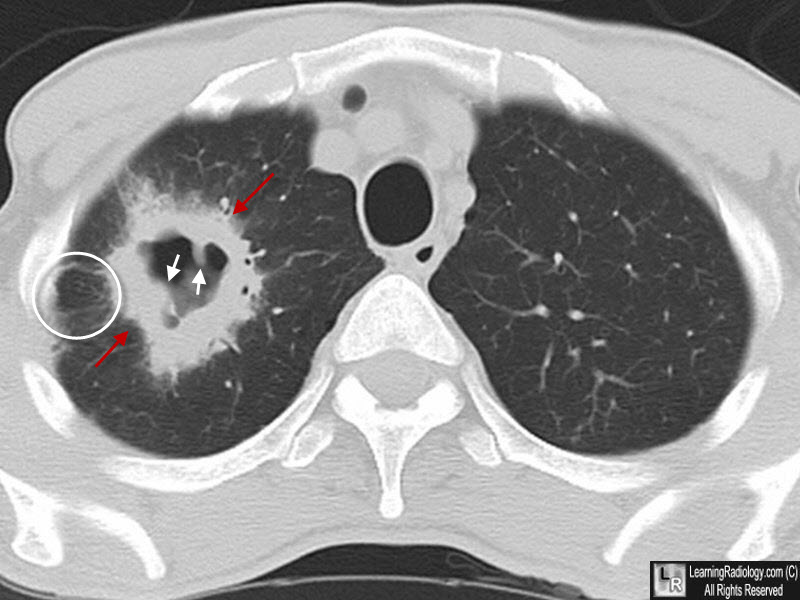 Cavitating Bronchogenic Carcinoma, Squamous Cell