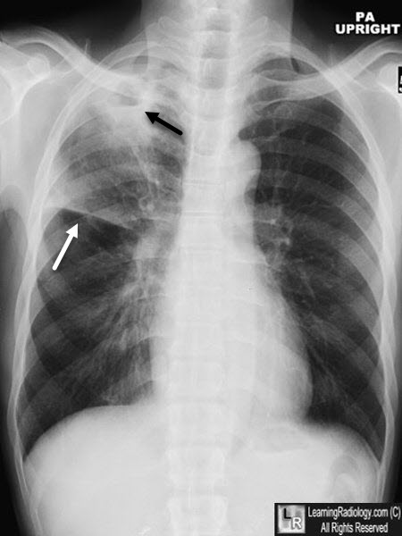 tuberculosis radiology ile ilgili görsel sonucu