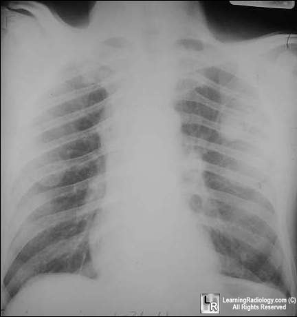 Aspergilloma