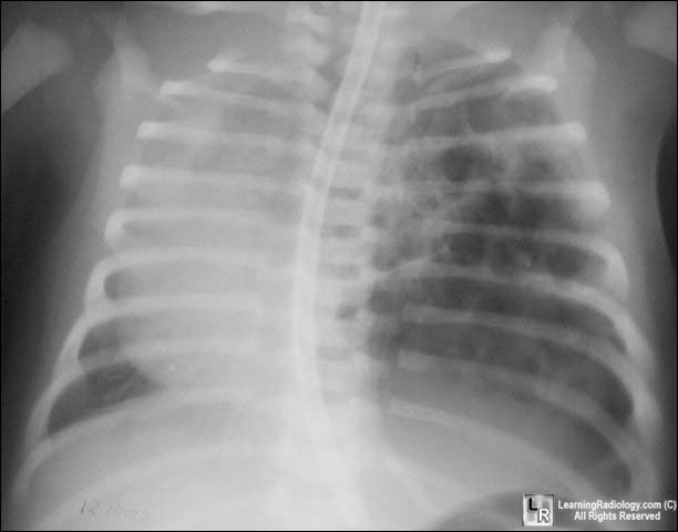 Cystic Adenomatoid Malformation