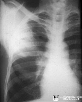 Abscess-staph