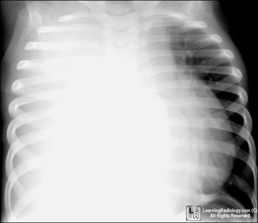 Large R Effusion