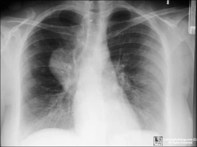 Neurofibromatosis