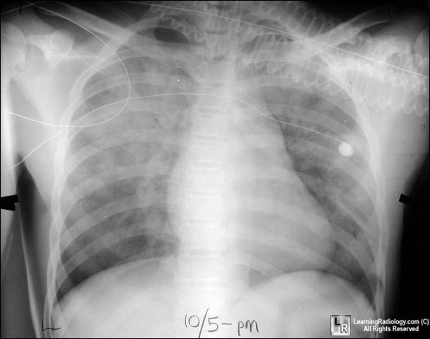 Noncardiac pulmonary edema