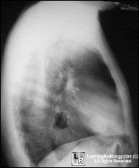 SPN-hamartoma