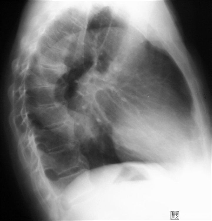 Atelectasis-RLL