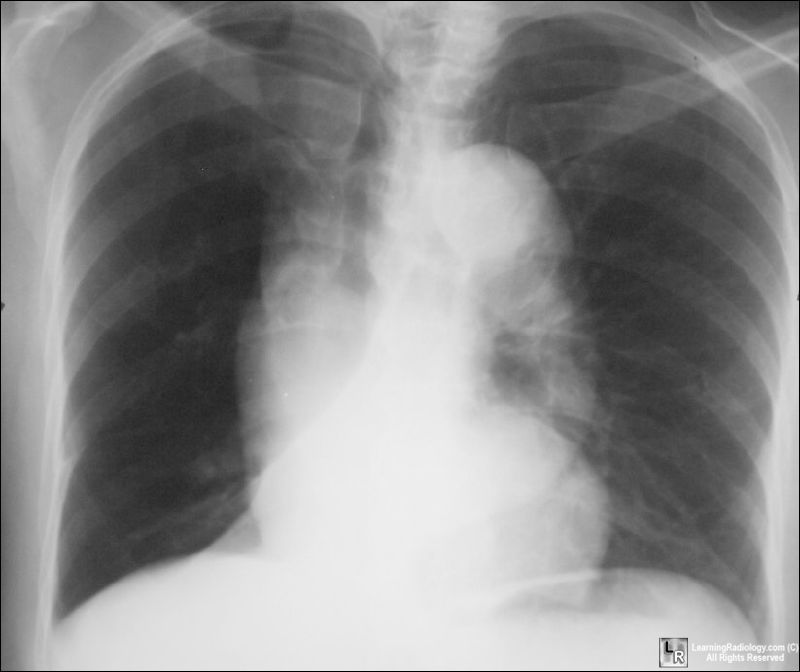 Atelectasis-RLL