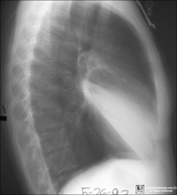 Atelectasis-RML