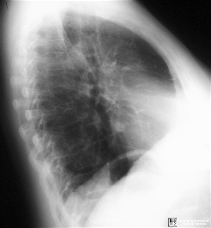 Atelectasis-RML