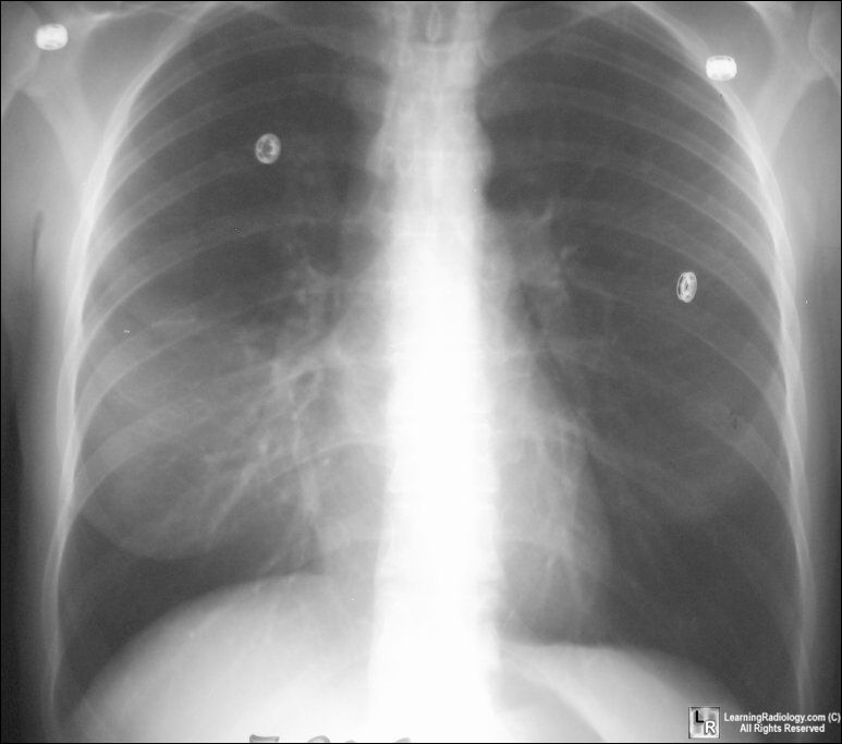 Atelectasis-RML