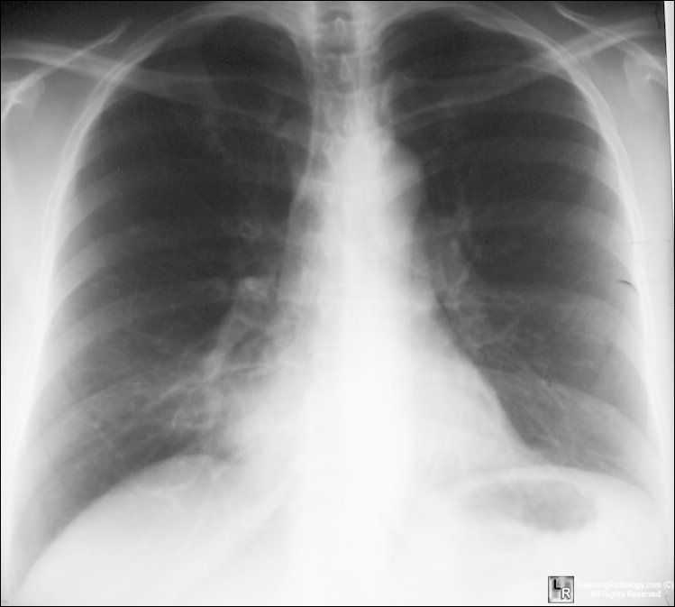 Atelectasis-RML