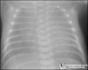 Hyaline Membrane Disease