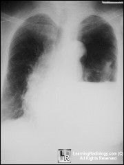 Hydropneumothorax