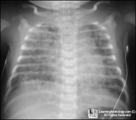 Meconium aspiration syndrome