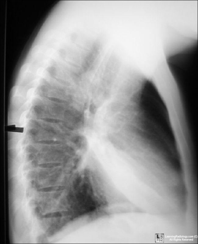 Pneumonia-lingula