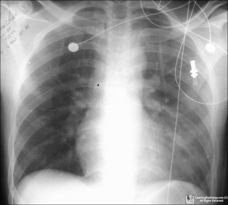 Pneumonia-lingula