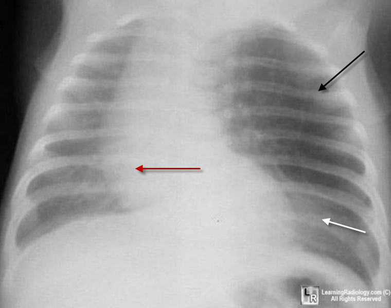 congenital lobar emphysema