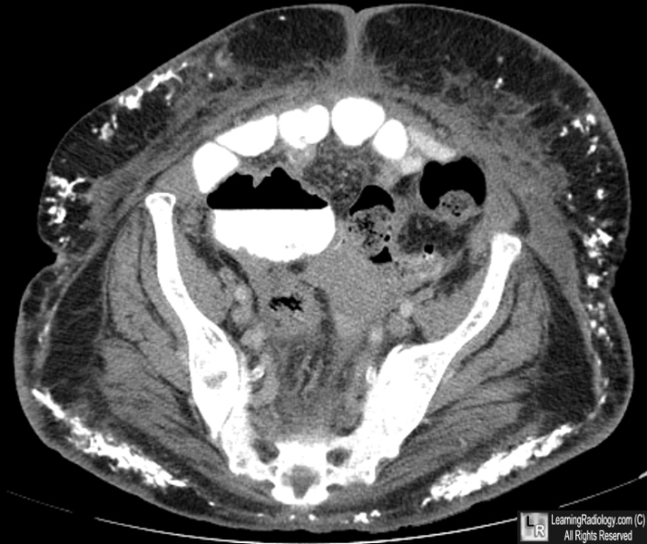 Dermatomyositis.