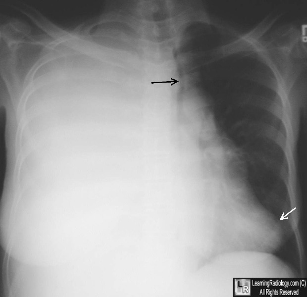 large effusion