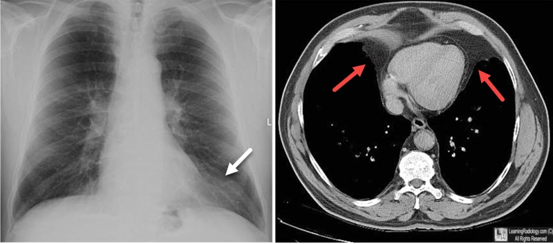 pericardial, epicardial, fat pad