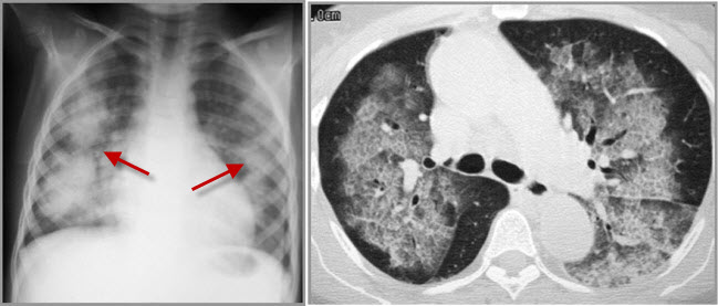 Goodpasture Syndrome