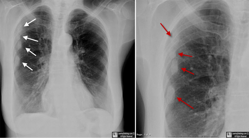 healing rib fractures