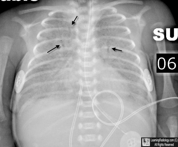 respiratory disesae of the newborn