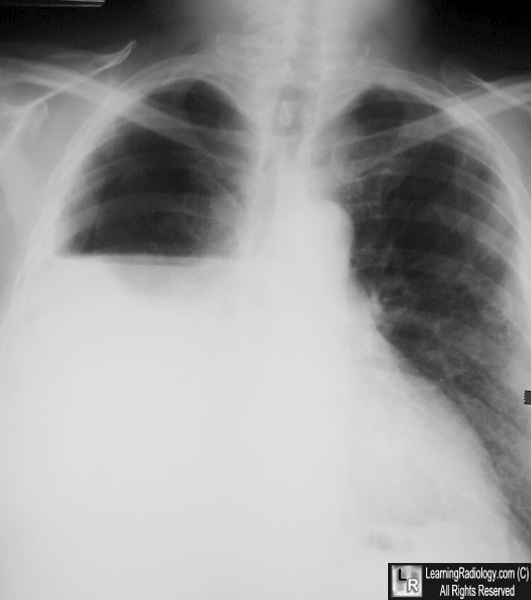 Hydropneumothorax