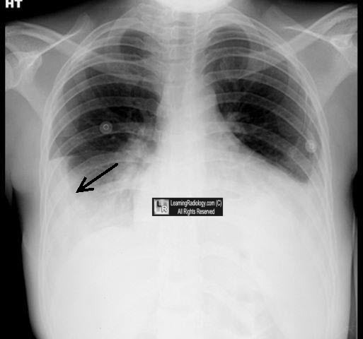 Incomplete Fissure