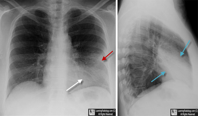 Lingular Pneumonia