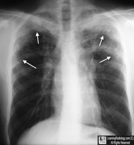 loeffler syndrome