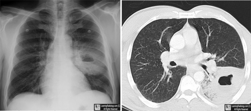 Lung Abscess