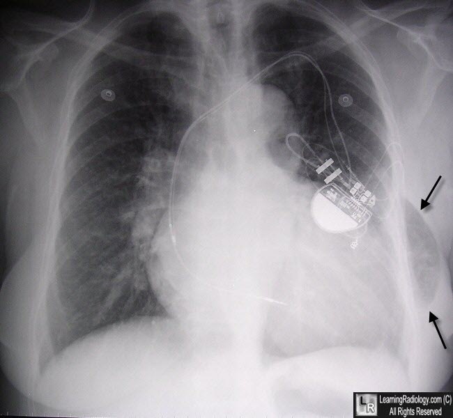 Lung Hernia