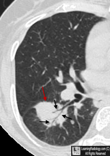 mass with air bronchogram