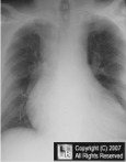 Mediastinal Lipomatosis